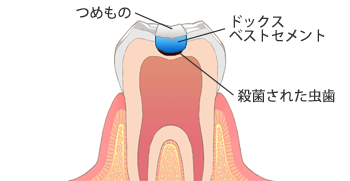 ドックスベストセメントの治療法