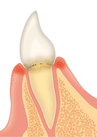 軽度の歯周病になると…