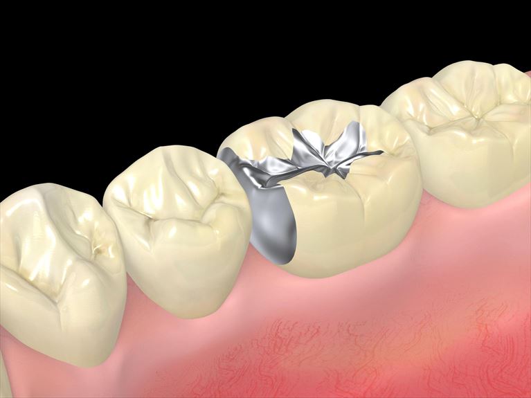 特に詰め物・被せ物の境目は虫歯になりやすい